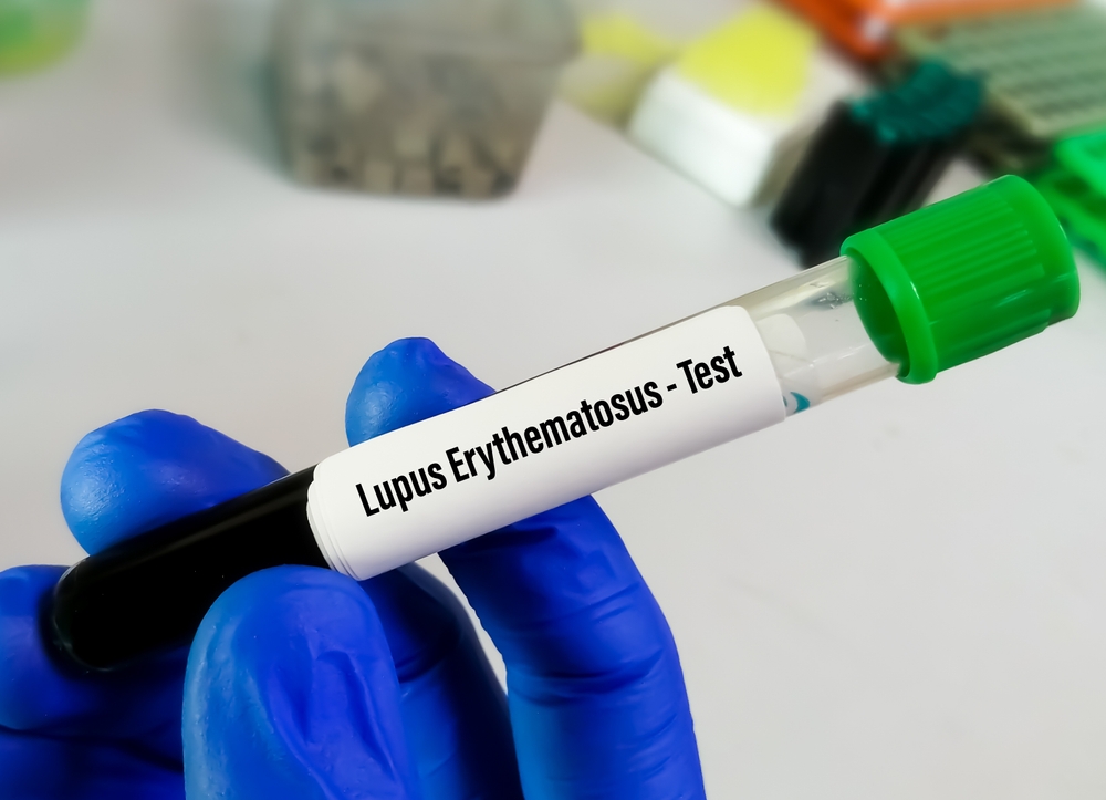 diagnosing Lupus swetech medical center