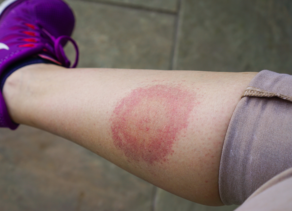 what is lyme disease swetech medical center